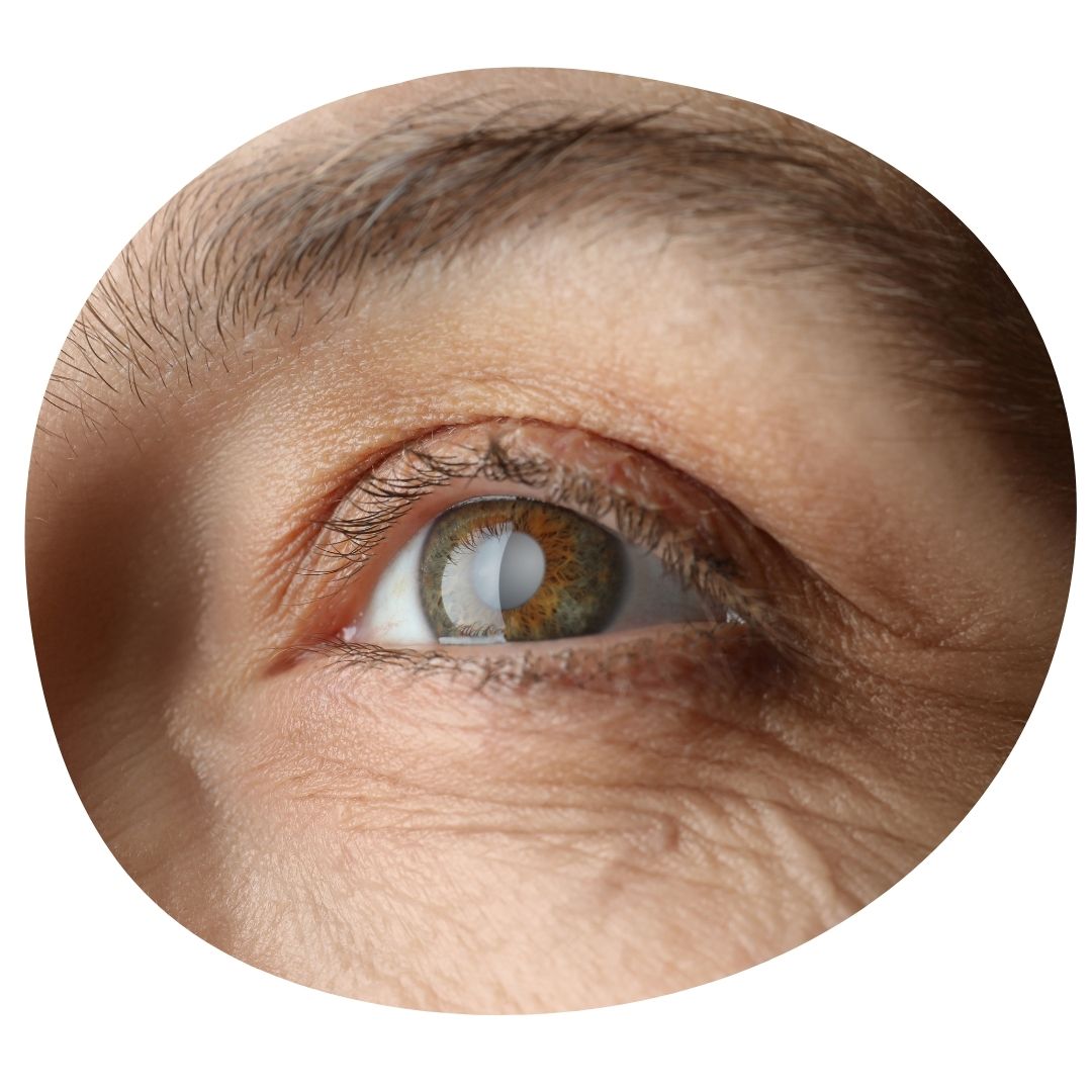 Pathologie courante : cataracte